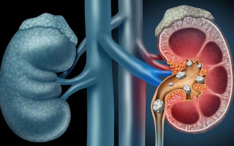 World Kidney Day 2022: Here are the things you should know about