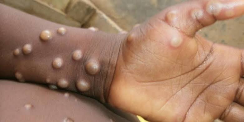 Monkeypox Cases : So far 4 cases of monkeypox have been reported in the country