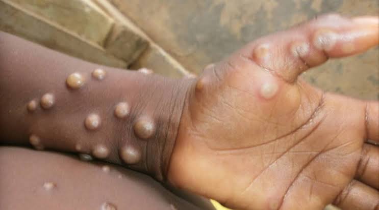 Monkeypox Virus : Health emergency in America due to monkeypox