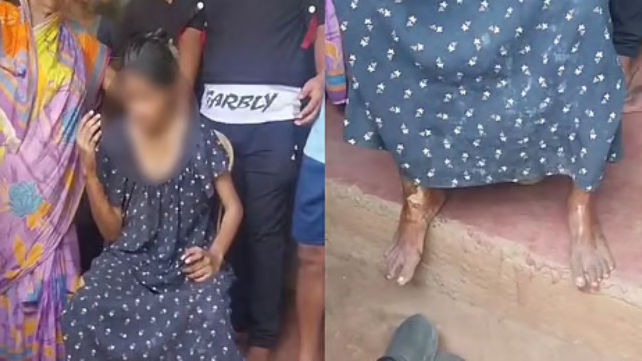 ‘She Was On Fire, Screaming’: Odisha Man Recalls Girl Seeking Help After Being Set Ablaze