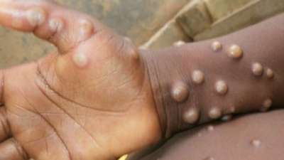 Monkeypox: First death due to monkeypox in America