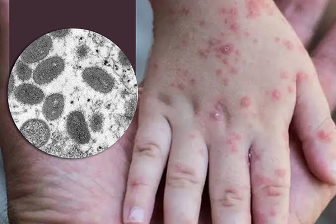 Monkeypox virus: 780 cases of monkeypox confirmed in 27 countries