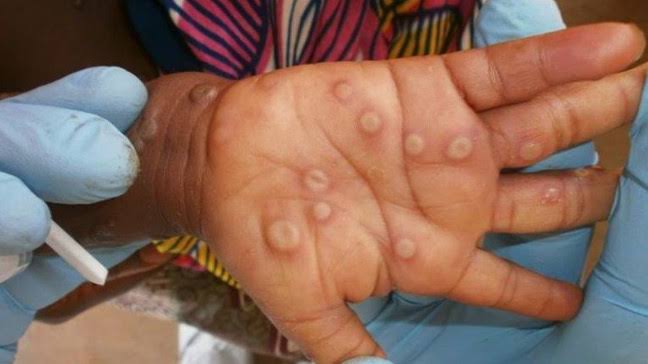 Former director of AIIMS said - Monkeypox is not contagious like Covid