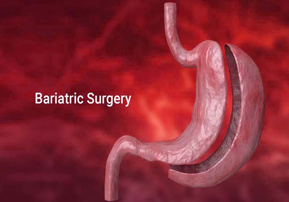 Delay in surgery increases the risk of Covid-19 among obese patients