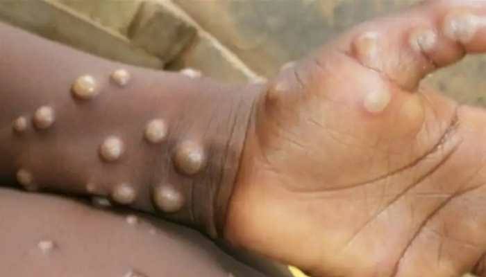Monkeypox Virus : First case of monkeypox found in India, report of UAE's Kerala returnee positive