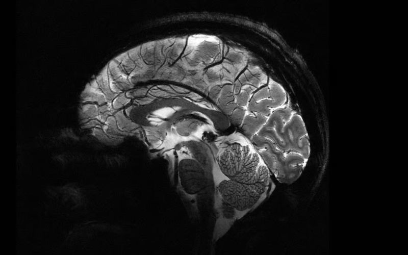 World's Most Powerful MRI Reveals First Images of Human Brain: A Breakthrough in Neuroscience