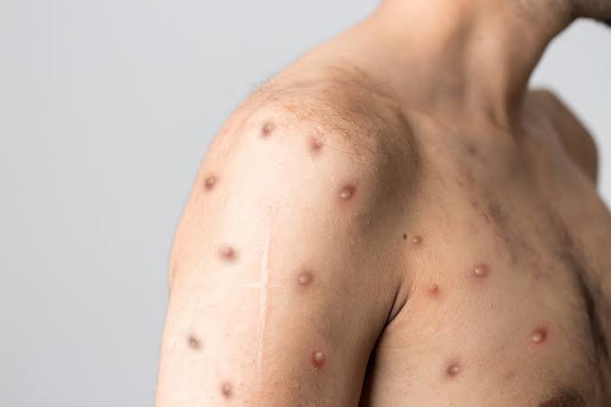 Monkeypox declared a global health emergency, WHO took steps in view of the increasing cases
